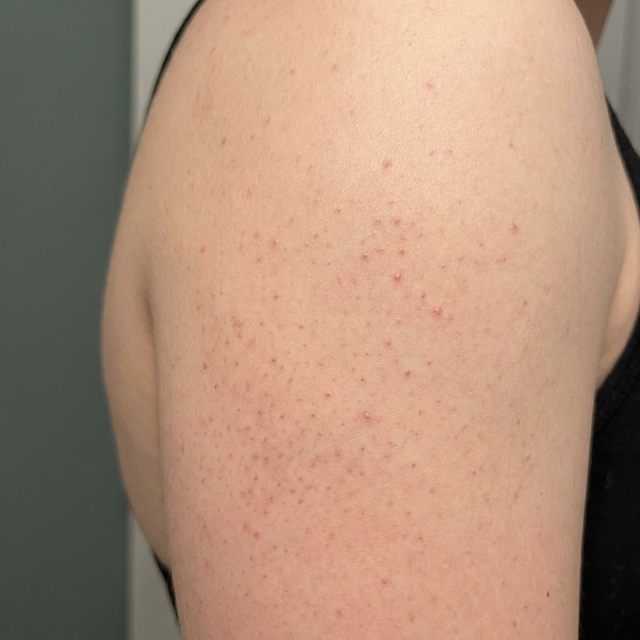 Keratosis pilaris kunskapsbank