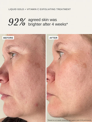 Alpha-H Liquid Gold + Vitamin C Exfoliating Treatment before after