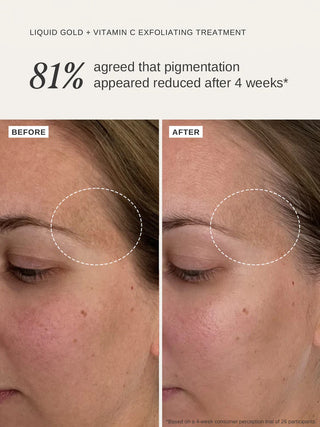 Alpha-H Liquid Gold + Vitamin C Exfoliating Treatment results