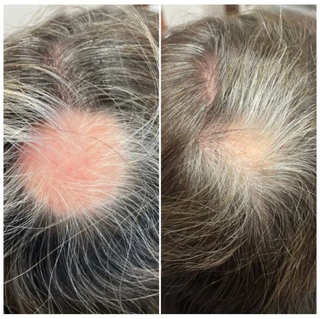 Calecim Advanced Hair System Kit 6 x ml results