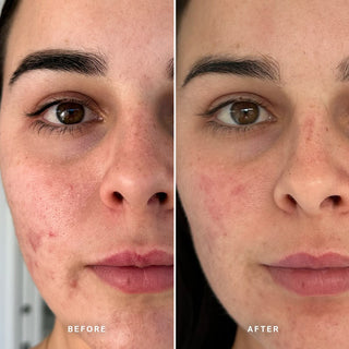 Alpha-H Clear Skin Tonic voor en na resultaat drie