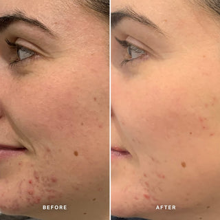 Alpha-H Clear Skin Tonic voor en na resultaat vier