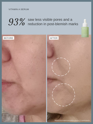 Alpha-H Vitamin A Serum voor en na minder zichtbare poriën